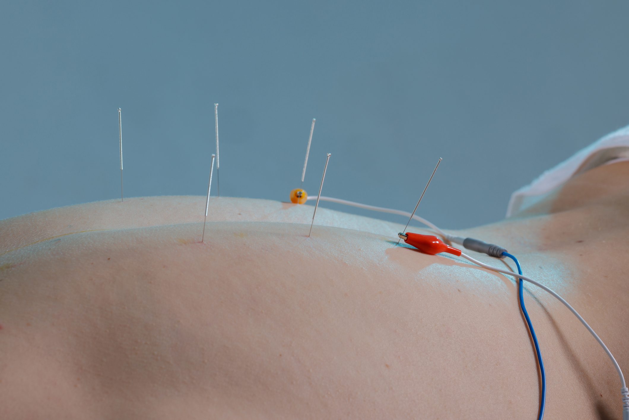 Close up of sterile needles connected to leads during electroacupuncture on the back, used for safe pain relief and rehabilitation.